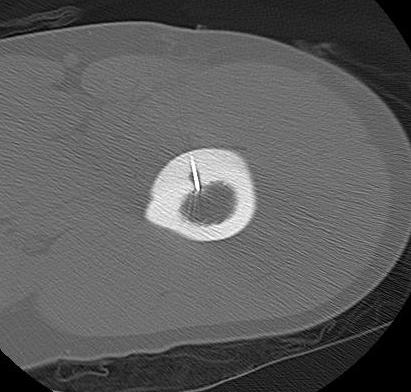 Osteoid Osteoma Radiofrequency Ablation0003